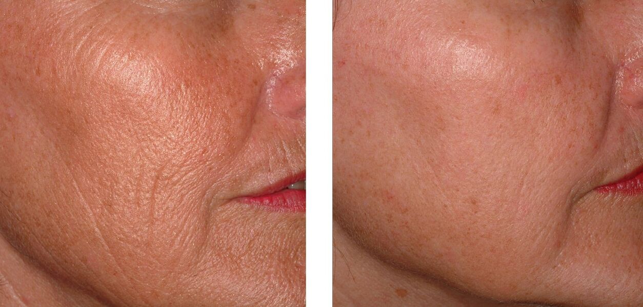 Rejuvenation of skin