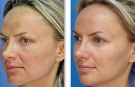 Laser peeling