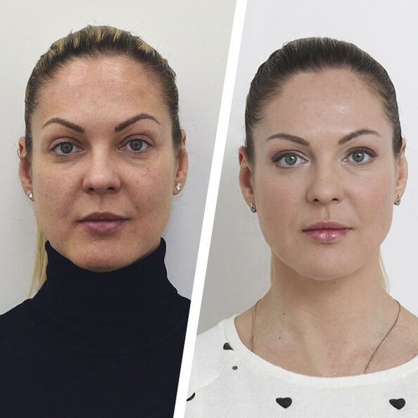 Before and after non-surgical facial skin rejuvenation