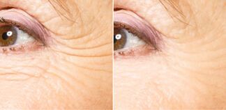Before and after fractional rejuvenation