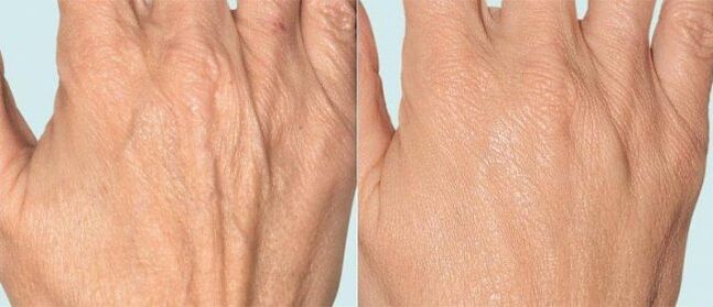 Hand skin before and after fractional treatment