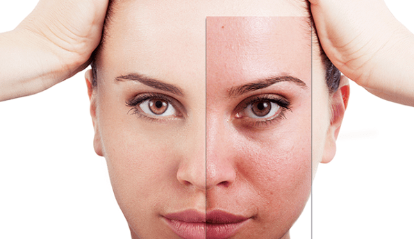 fractional rejuvenation eliminates basic aesthetic defects on the face